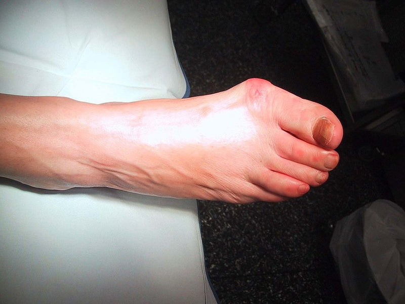 What Does Bunion Pain Feel Like?